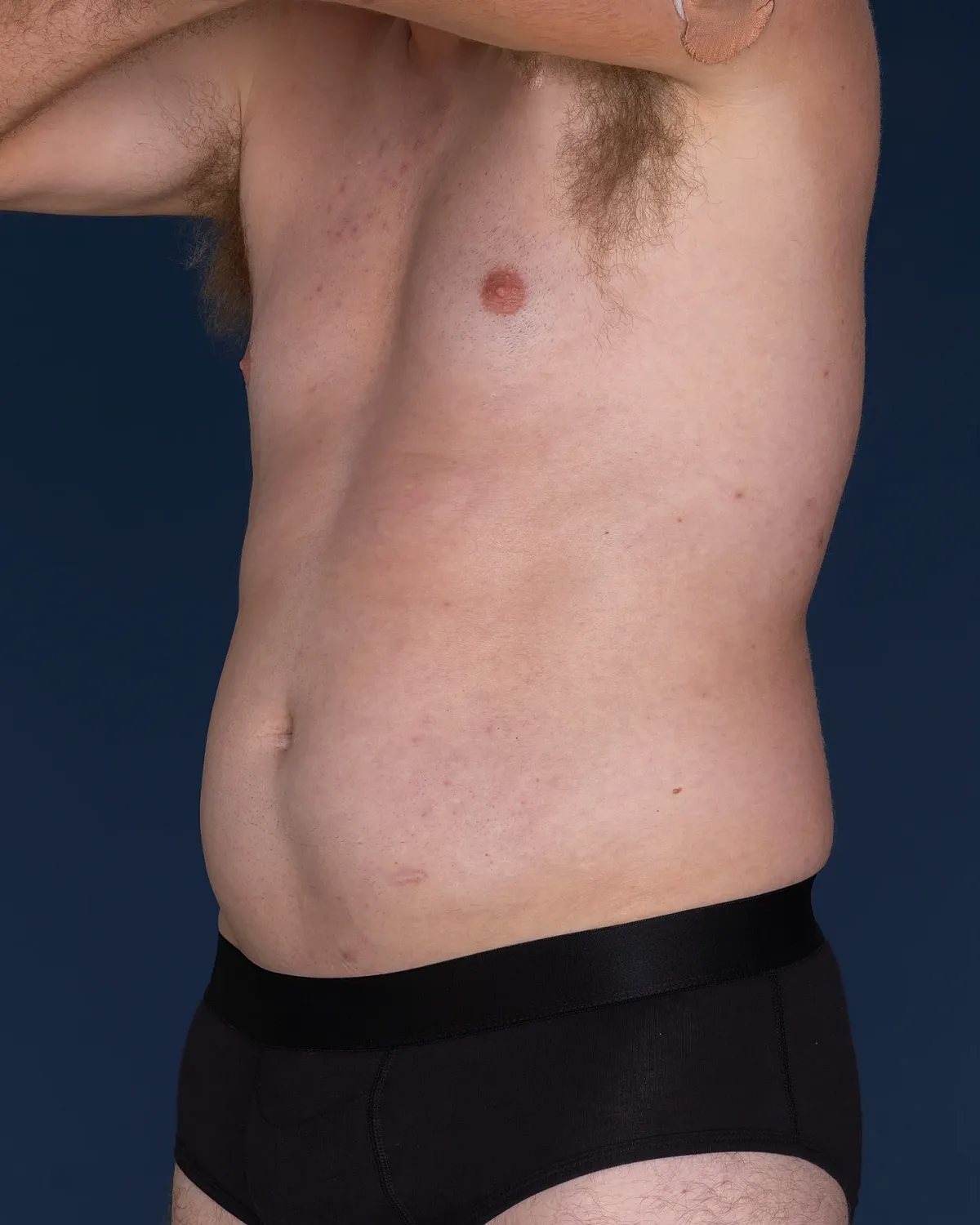 Coolsculpting Before & After