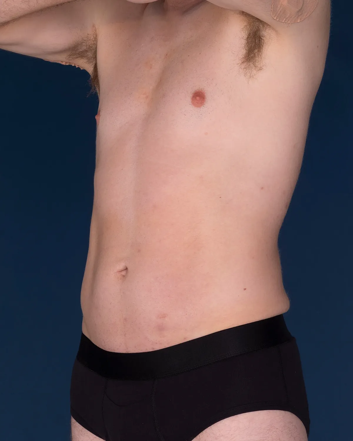 Coolsculpting Before & After