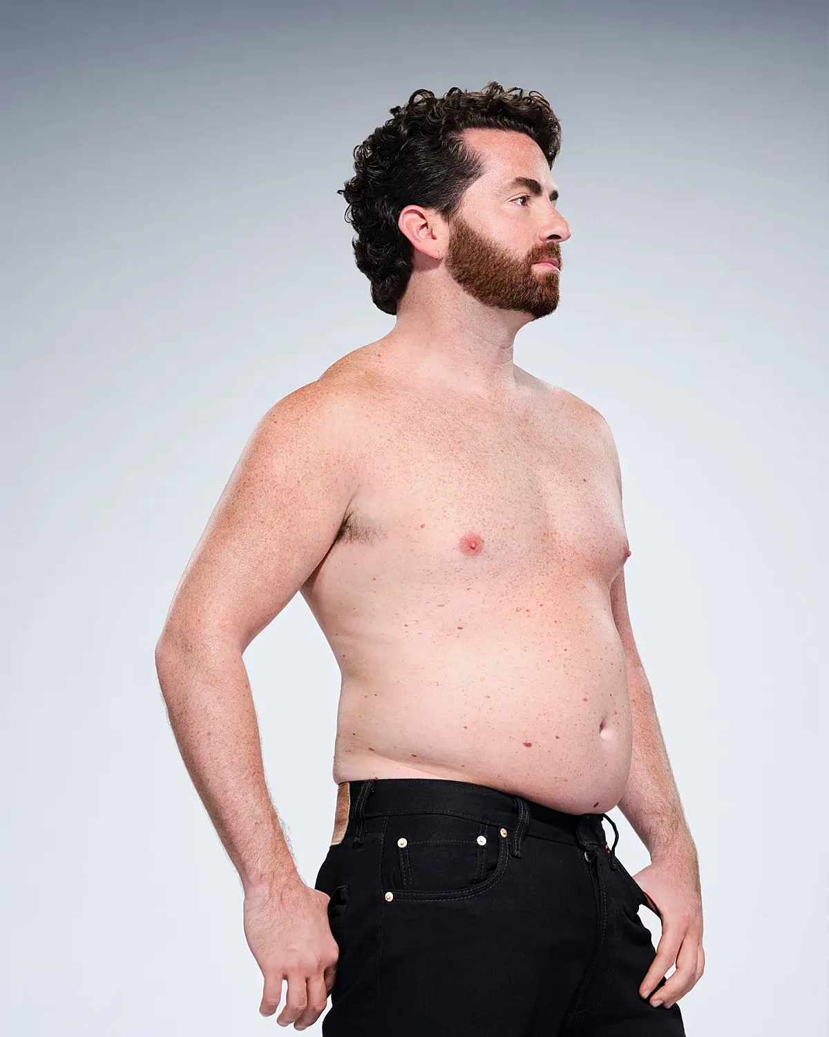 Coolsculpting Before & After