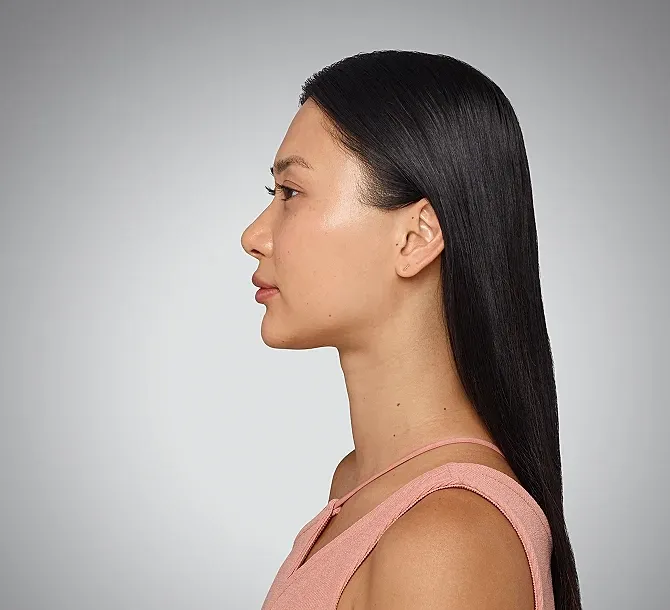 Juvederm Before & After